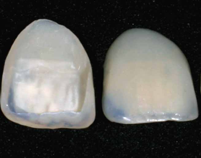 Veneer sứ mỏng trước khi gắn lên mặt ngoài răng — dán veneer là phương pháp thẩm mỹ, còn keo dán là vật liệu gắn kết