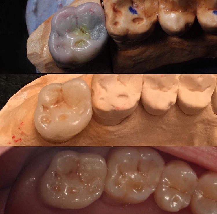 Mão sứ toàn phần nhìn từ bên trong trước khi gắn keo dán — bề mặt bên trong được xử lý để tăng độ bám dính