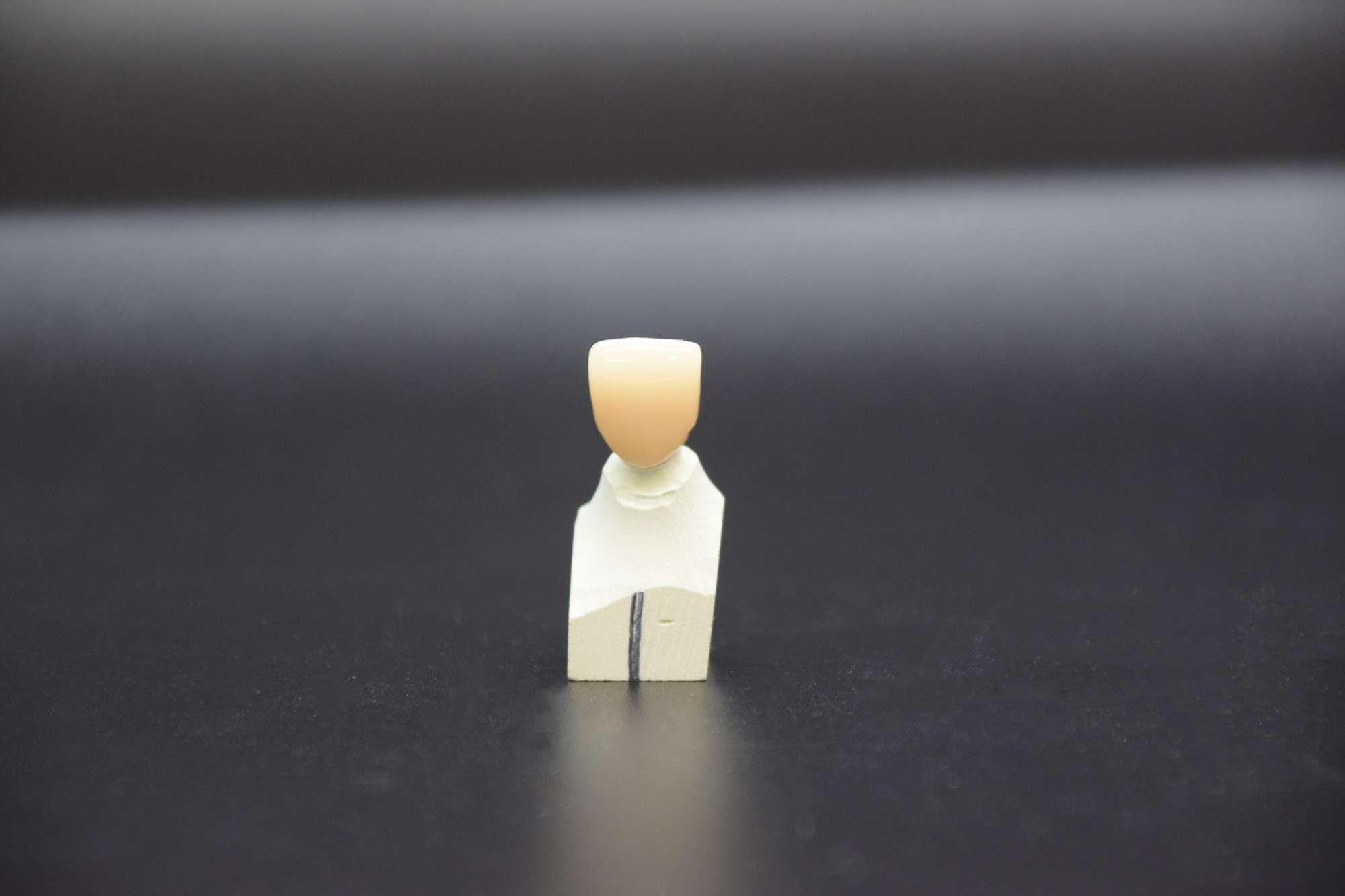 Mão sứ zirconia đơn lẻ vùng răng cửa — loại phục hình này yêu cầu keo resin với kỹ thuật dán chính xác